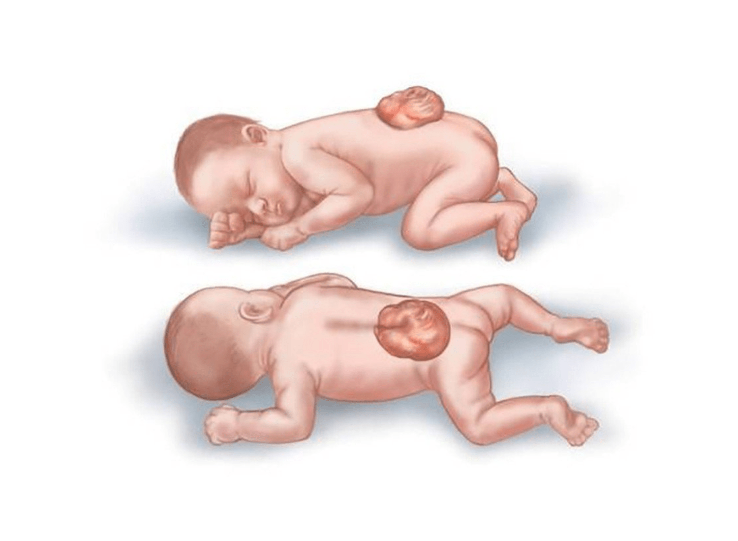 Dị tật ống thần kinh ở thai nhi